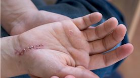 צלקת, צילום: דוברות ארגון המנתחים הפלסטים אסתטיים בישראל